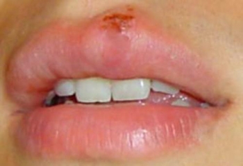 herpes.jpg