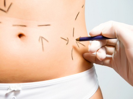 lipoescultura1